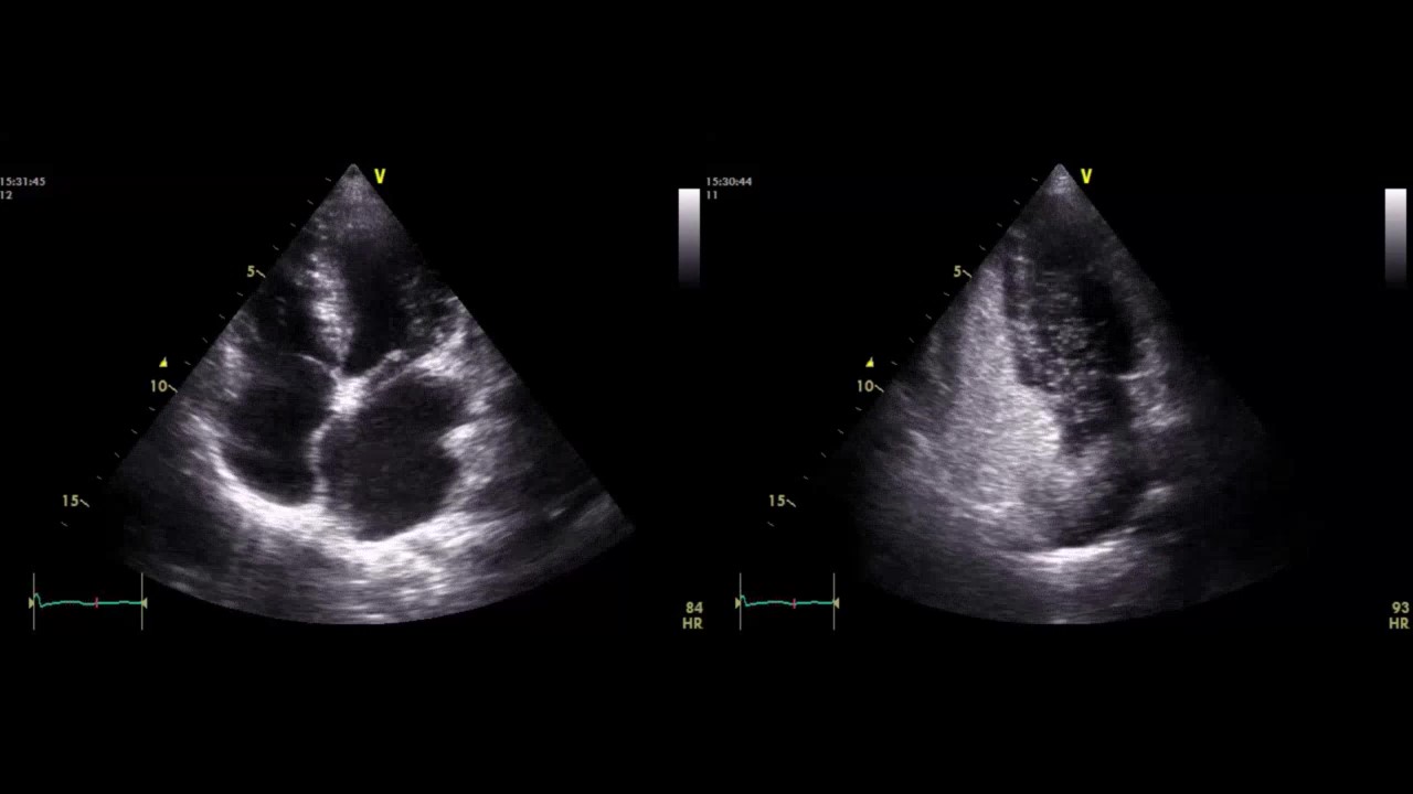 Agitated saline echo test (Bubble study)